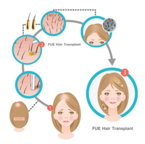 Hair Wigs VS Hair Transplant
